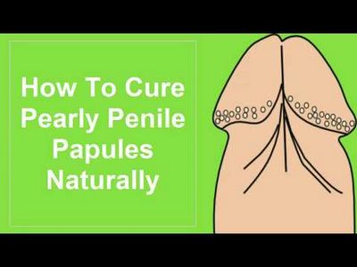 How to Treat a Papule