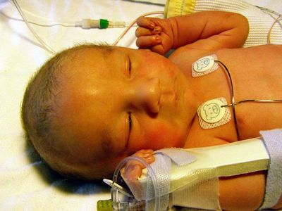 Ways To Treat Your Newborn Baby From Jaundices