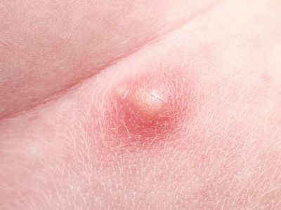 What are a Pustule and How Do You Get One?