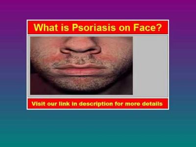 What Is Psoriasis On Face - How to Understand It